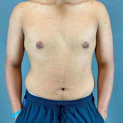 Gynecomastia Before & After Patient #622