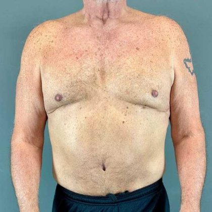 Gynecomastia Before & After Patient #629