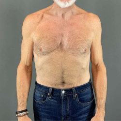 Gynecomastia Before & After Patient #642