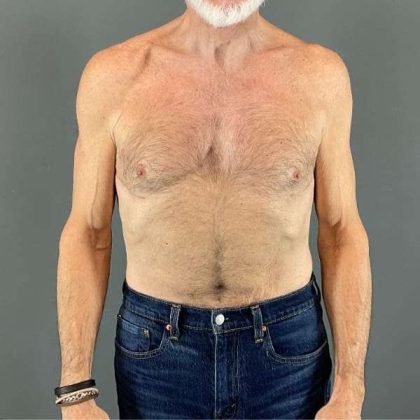 Gynecomastia Before & After Patient #642
