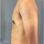 Gynecomastia Before & After Patient #653