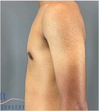 Gynecomastia Before & After Patient #653