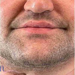 Injectables&Fillers Before & After Patient #150