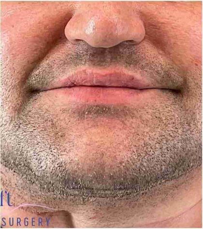 Injectables&Fillers Before & After Patient #150