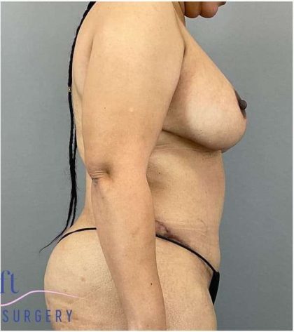 Breast Reduction Before & After Patient #664