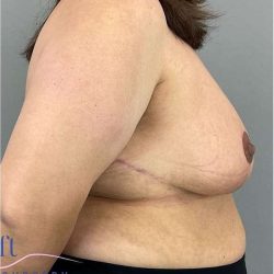 Breast Reduction Before & After Patient #675