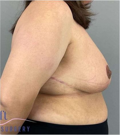 Breast Reduction Before & After Patient #675