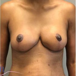 Breast Reduction Before & After Patient #686