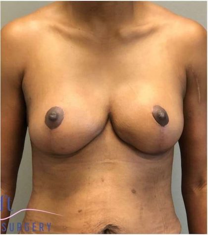 Breast Reduction Before & After Patient #686