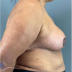 Breast Reduction Before & After Patient #708