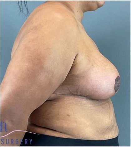 Breast Reduction Before & After Patient #708