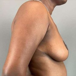 Breast Reduction Before & After Patient #730