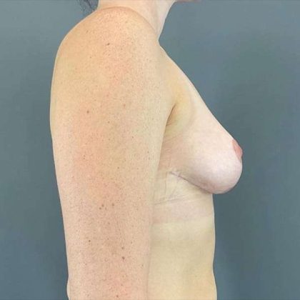 Breast Reduction Before & After Patient #741