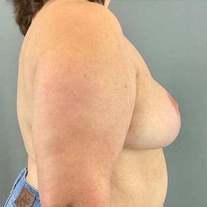 Breast Reduction Before & After Patient #763
