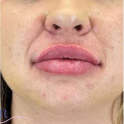 Injectables&Fillers Before & After Patient #155