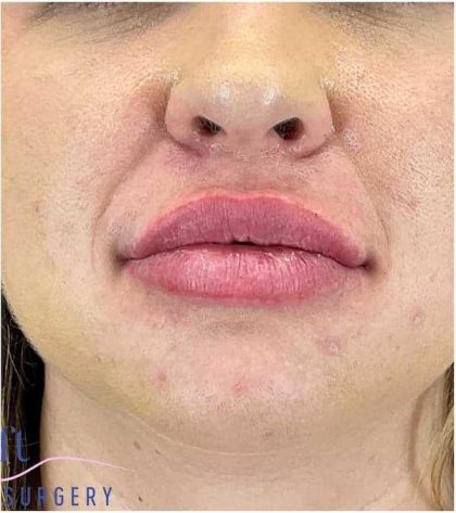Injectables&Fillers Before & After Patient #155