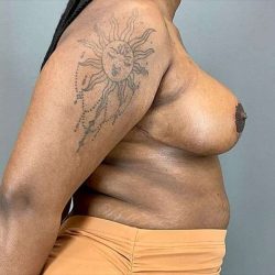 Breast Reduction Before & After Patient #774
