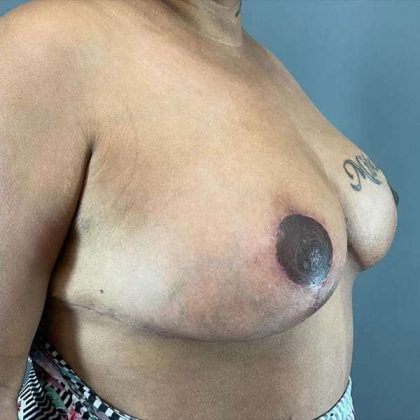Breast Reduction Before & After Patient #792