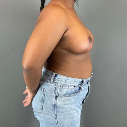 Breast Reduction Before & After Patient #828