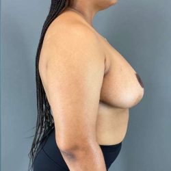 Breast Reduction Before & After Patient #850