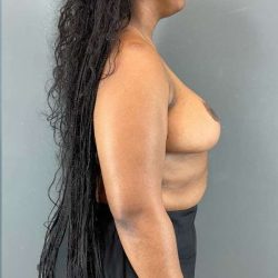 Breast Reduction Before & After Patient #861