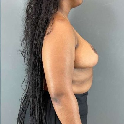 Breast Reduction Before & After Patient #861