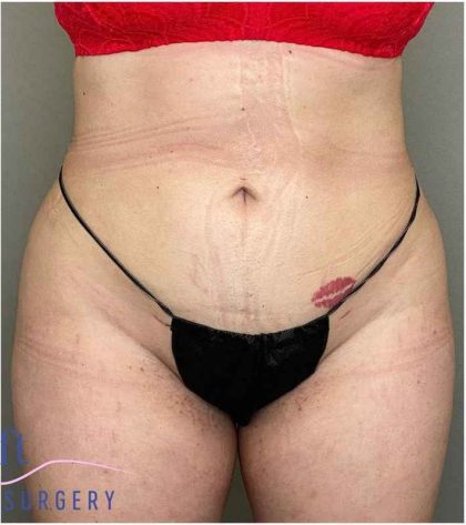 Liposuction Before & After Patient #166