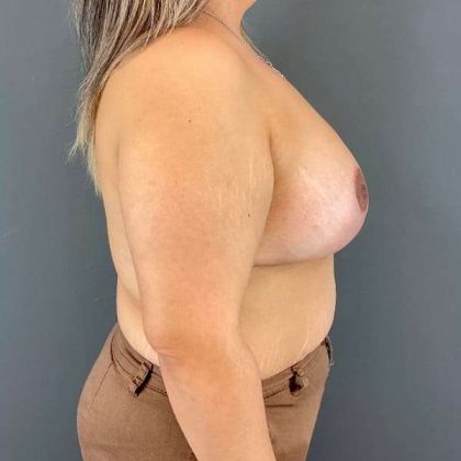 Breast Reduction Before & After Patient #872