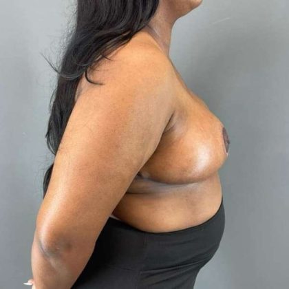 Breast Reduction Before & After Patient #883