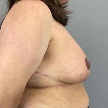 Breast Reduction Before & After Patient #894