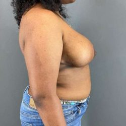 Breast Reduction Before & After Patient #916