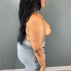 Breast Reduction Before & After Patient #927