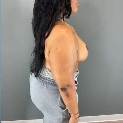 Breast Reduction Before & After Patient #927
