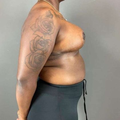 Breast Reduction Before & After Patient #938