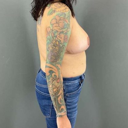 Breast Reduction Before & After Patient #949