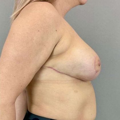 Breast Reduction Before & After Patient #956