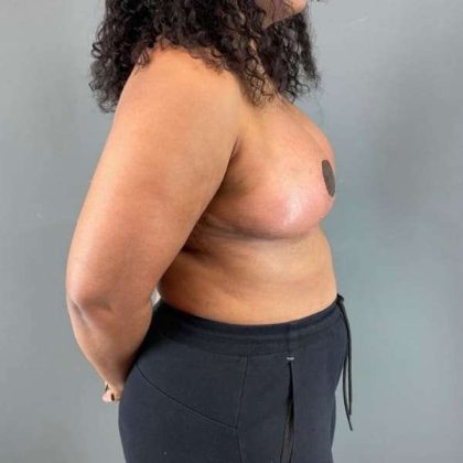 Breast Reduction Before & After Patient #967