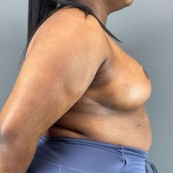 Breast Reduction Before & After Patient #978