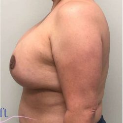 Breast Lift Before & After Patient #1040
