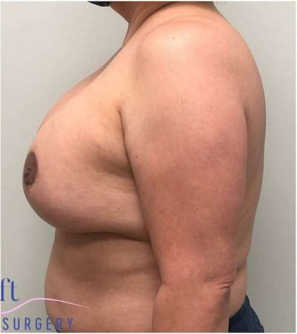 Breast Lift Before & After Patient #1040