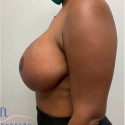 Breast Lift Before & After Patient #1051