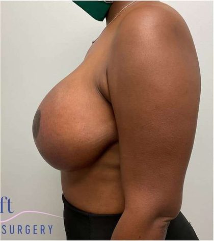 Breast Lift Before & After Patient #1051