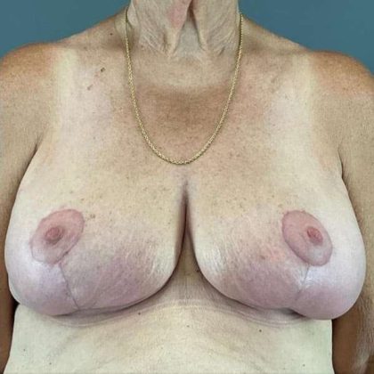 Breast Lift Before & After Patient #1062
