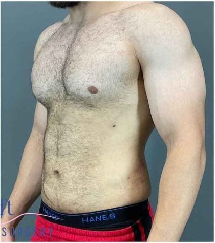 Liposuction Before & After Patient #188