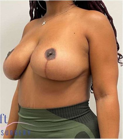 Breast Lift Before & After Patient #1098