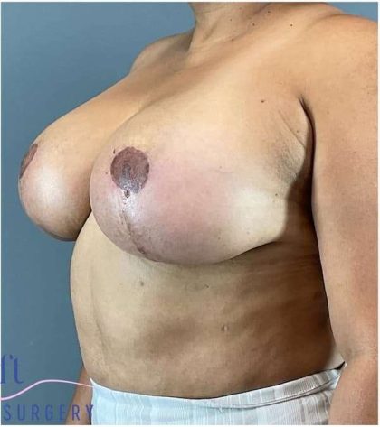 Breast Lift Before & After Patient #1131