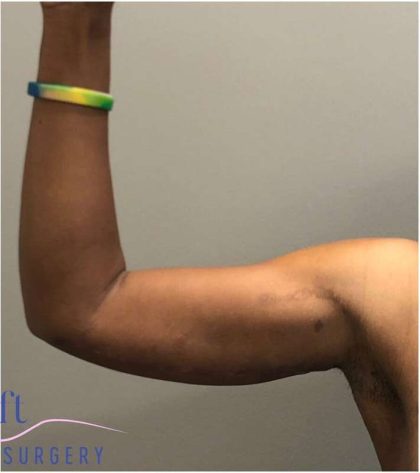 Arm Lift Before & After Patient #193