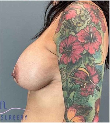 Breast Augmentation Before & After Patient #1197