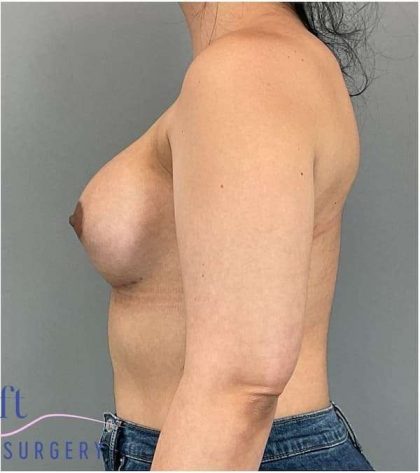 Breast Augmentation Before & After Patient #1219