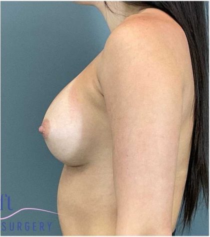 Breast Augmentation Before & After Patient #1252